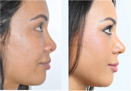 tip rhinoplasty in india