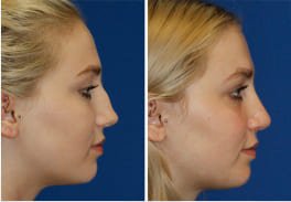 bridge rhinoplasty in india