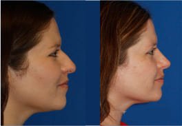 Hump Rhinoplasty in India