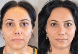 Cartilage Rhinoplasty in India