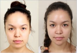 Angle Rhinoplasty in India