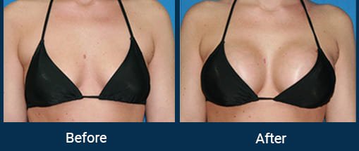 Breast Implant in Indore Bhopal, Breast Enlargement in Indore Bhopal, Breast Augmentation in Indore Bhopal, Breast Implant Surgery Cost in Indore Bhopal, Breast Implant Price in Indore Bhopal